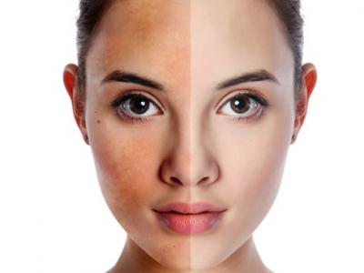 bệnh nám da bệnh nám da