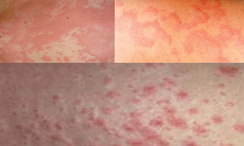 dấu hiệu nổi mày đay dấu hiệu nổi mày đay