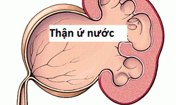 thận ứ nước thận ứ nước