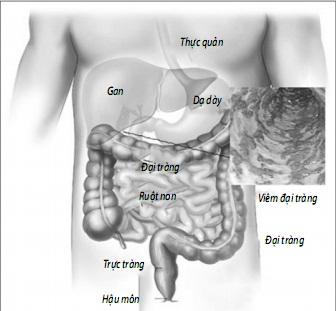 bệnh viêm đại tràng bệnh viêm đại tràng