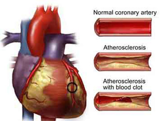 Bệnh xơ vữa động mạch là gì?