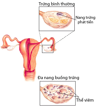 Cách chữa bệnh đa nang buồng trứng