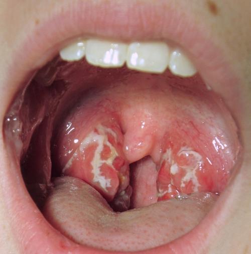 Chữa viêm amidan cực hiệu quả