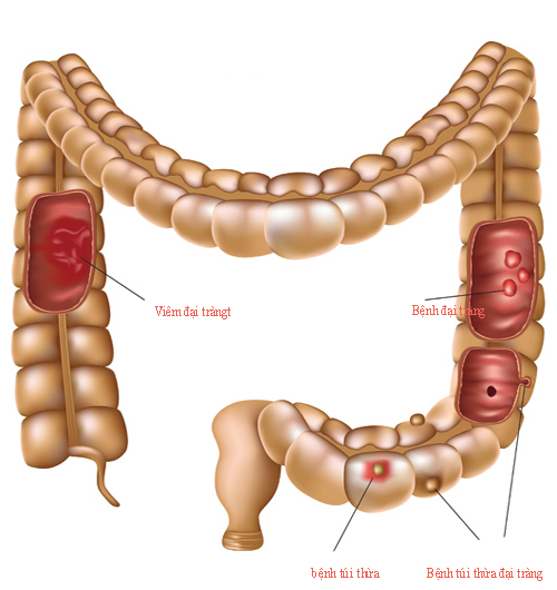 Dấu hiệu đường ruột của bạn có vấn đề