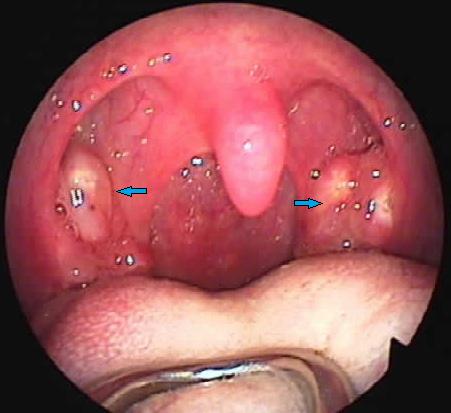 Khi yết hầu thũng thống phải làm thế nào
