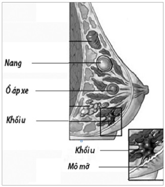 Làm gì khi bị áp xe tuyến vú