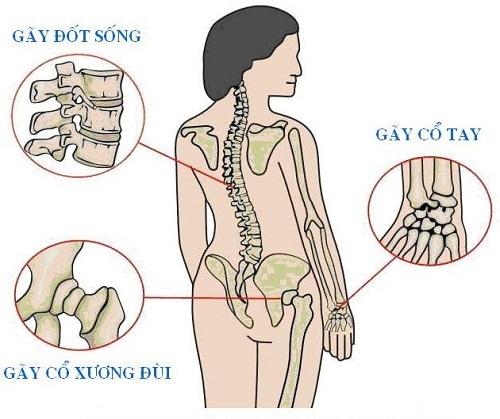 Món ăn hằng ngày chữa bệnh loãng xương cực tốt