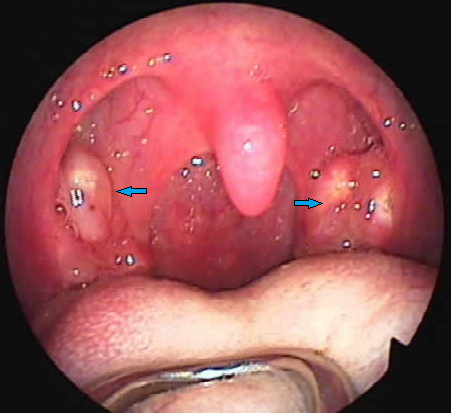 Tấn Phát giới thiệu bài thuốc trị yết hầu sưng đau