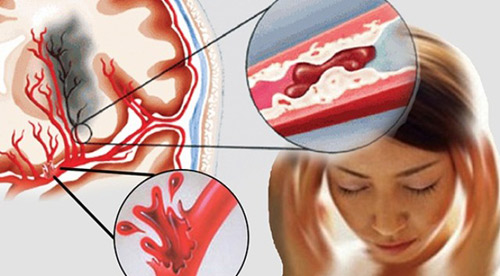 sản phẩm ngừa tai biến đột quỵ