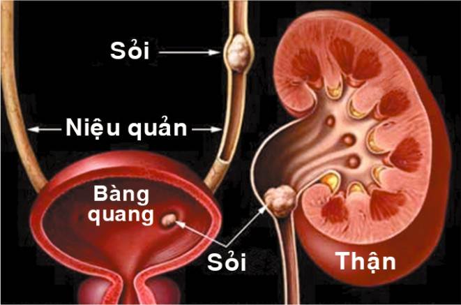 Món Ăn Điều Trị Sỏi Tiết Liệu Tốt Hàng ngày